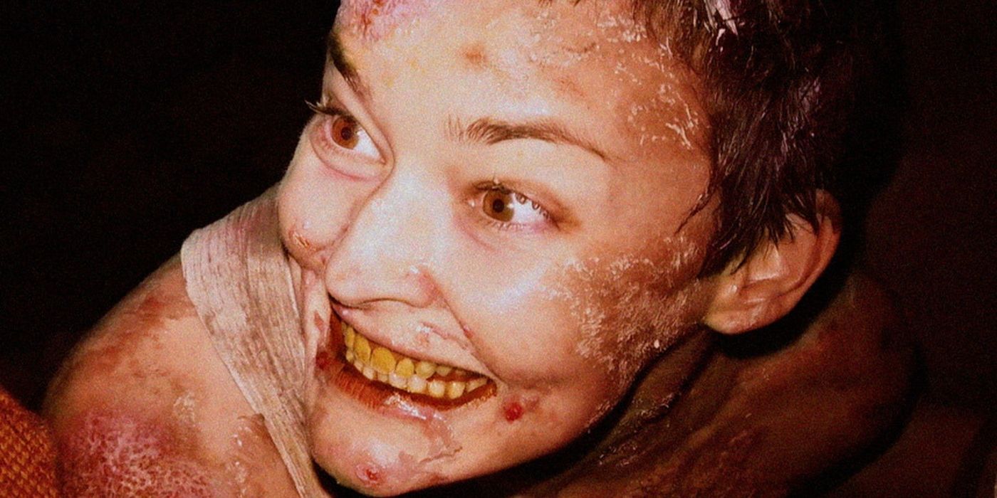 A close-up of a burned and bruised young woman